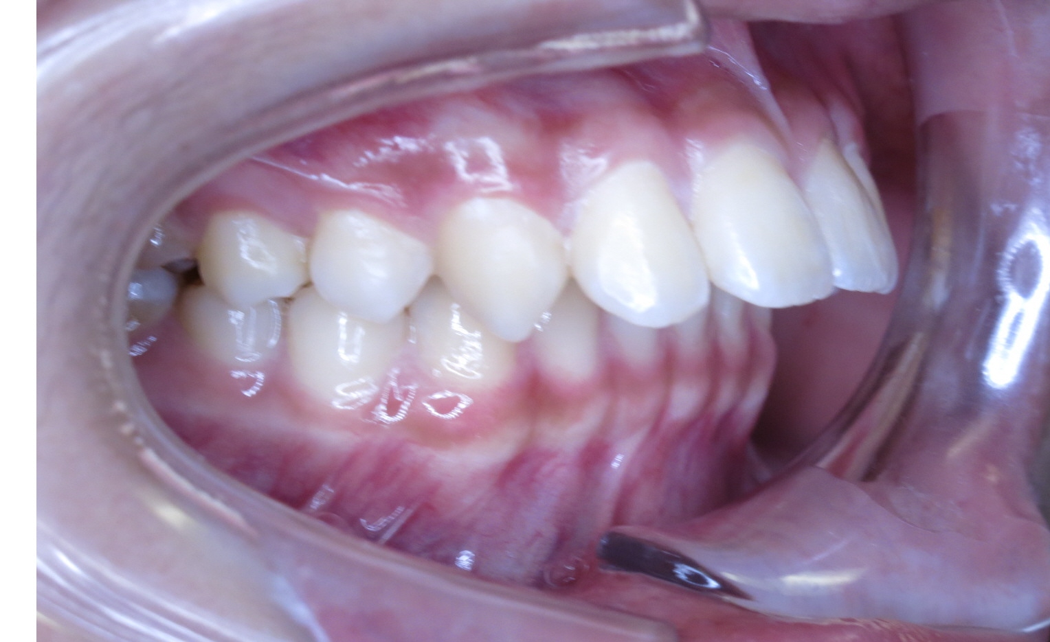 Before and After Oakridge Orthodontics Vancouver BC